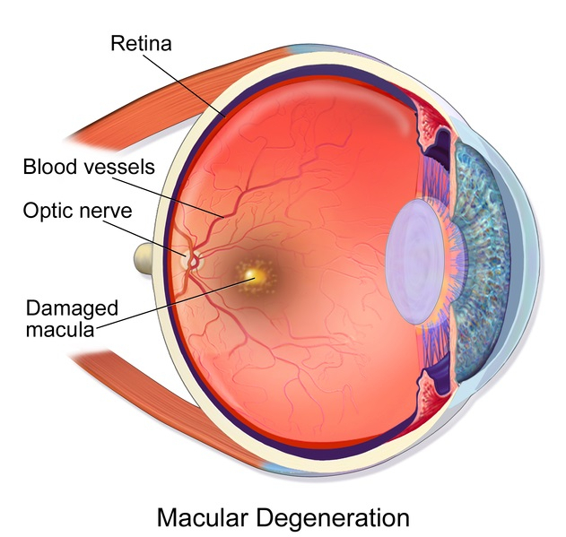 Eye Disease