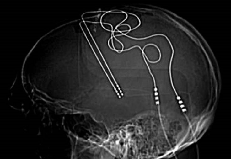 Deep brain stimulation (DBS)