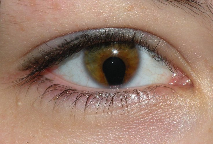 Coloboma