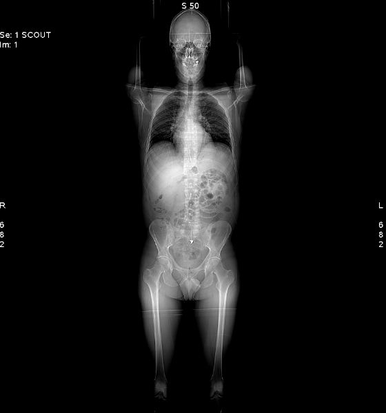 CT Scan CT Scan