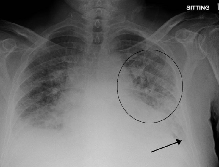 Pulmonary edema 