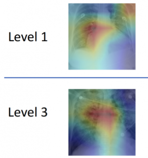 Pulmonary edema 