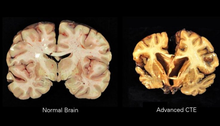  Encephalopathy