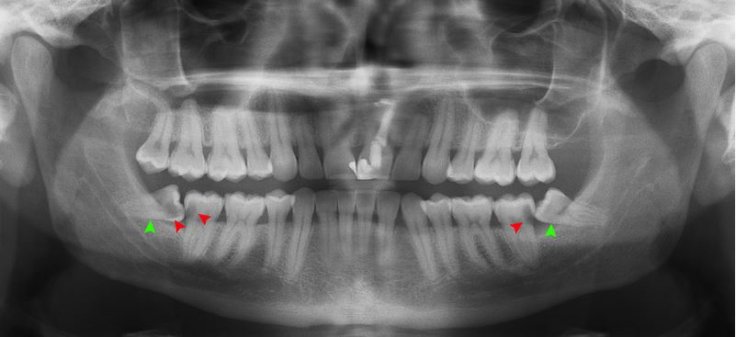 Wisdom teeth