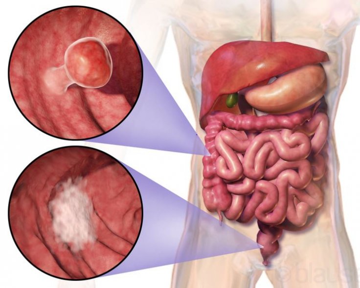 Colorectal Cancer