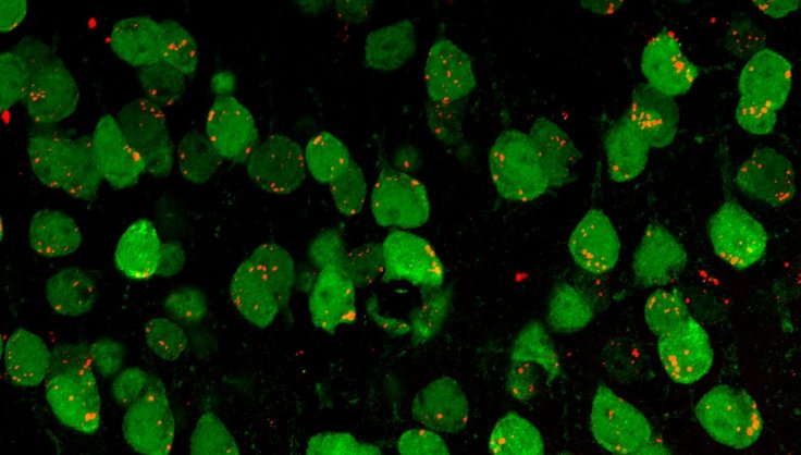 Brain damage extracellular vesicles