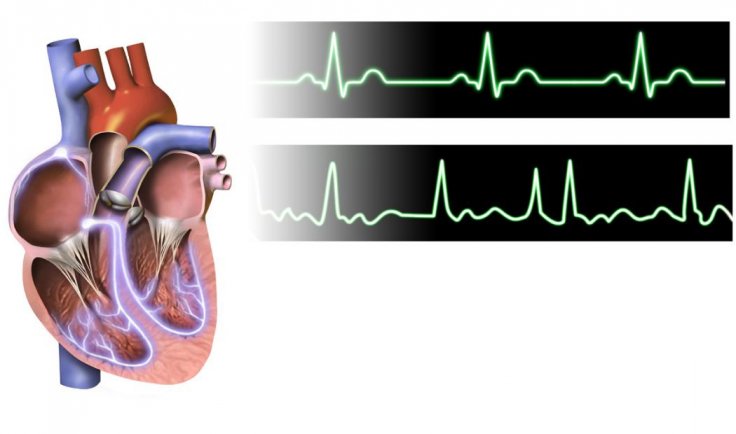 Atrial Fibrillation