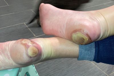 Patricia Chandler, from Texas, developed painful sores on her foot Patricia Chandler, from Texas, developed painful sores on her foot