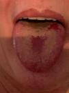 COVID tongue