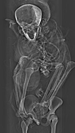 X ray of pharaoh Seqenenre-Taa-IIs torso X ray of pharaoh Seqenenre-Taa-IIs torso