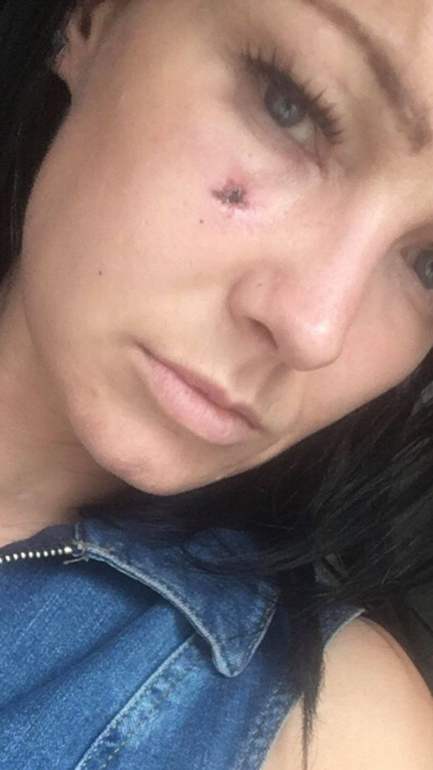 Stacy Dolan Stabbed with screwdriver on face Stacy Dolan Stabbed with screwdriver on face