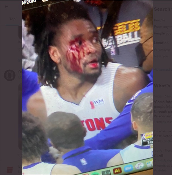 Stewart bleeding after being elbowed by James Stewart bleeding after being elbowed by James