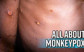 all-about-monkeypox-as-massachusetts-reports-first-case-in-the-us