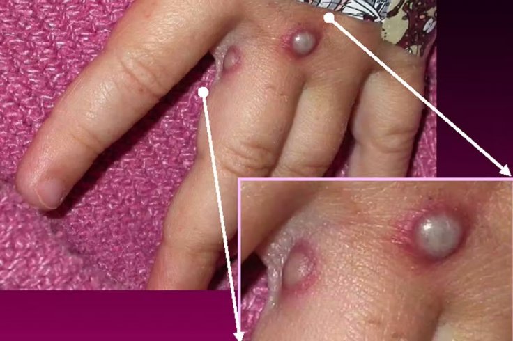 Symptoms of Monkeypox disease