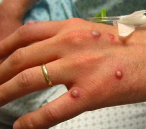 Symptome der Monkeypox-Krankheit