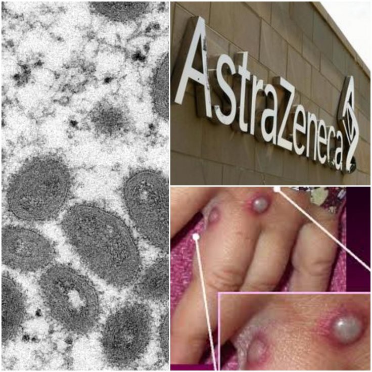 A false claim suggests the AstraZeneca COVID-19 vaccine causes Monkeypox infections.