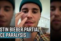 justin-bieber-partial-face-paralysis-what-ramsay-hunt-syndrome-mean