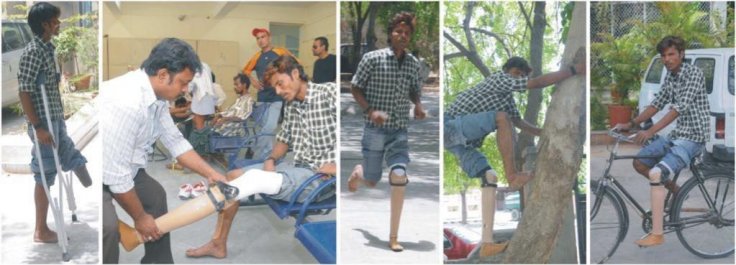 During a recent limb fitment camp in BMVSS HQ in Jaipur, a differently-abled youth came on crutches, but walked out with an artificial limb on the same day. 