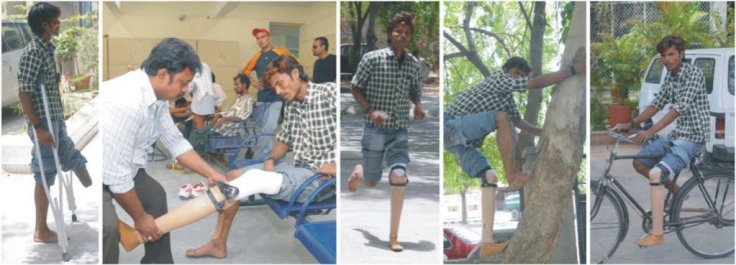 During a recent limb fitment camp in BMVSS HQ in Jaipur, a differently-abled youth came on crutches, but walked out with an artificial limb on the same day. During a recent limb fitment camp in BMVSS HQ in Jaipur, a differently-abled youth came on crutches, but walked out with an artificial limb on the same day.