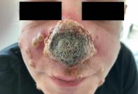 Monkeypox nose Monkeypox nose