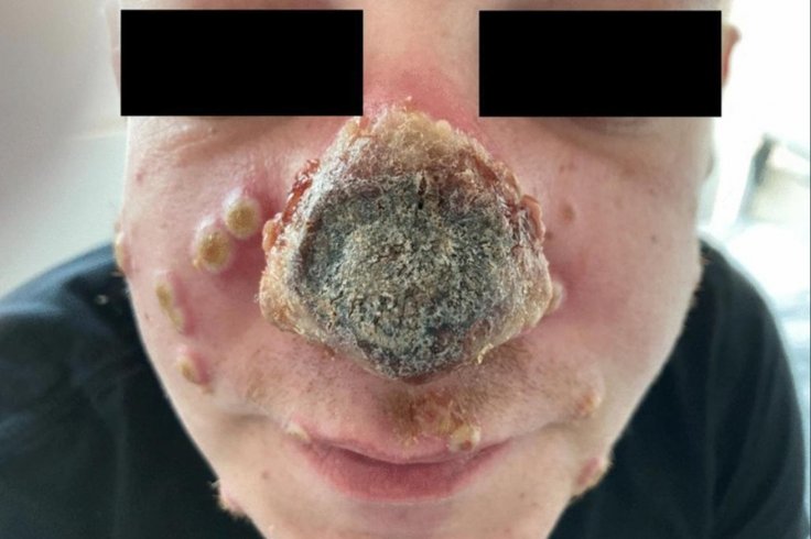 Monkeypox nose