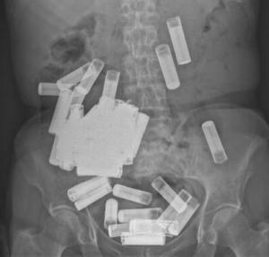 X-ray of patient's stomach