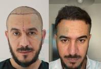 Turkish Hair Transplant