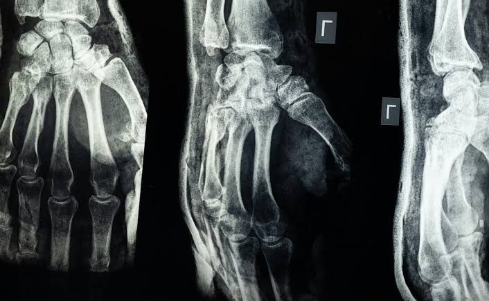 China invents bone glue