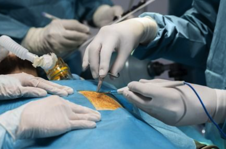 Gastric Bypass Surgery