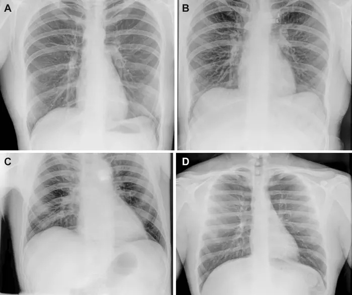 Radiographs of the chest Radiographs of the chest