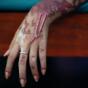 Acid attack Acid attack