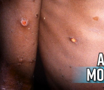 all-about-monkeypox-as-massachusetts-reports-first-case-in-the-us